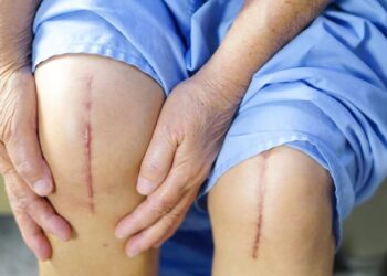 How To Choose Between Total And Partial Knee Replacement